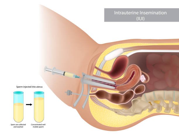 Embryo Transfer