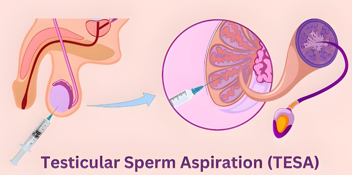 Testicular Sperm Aspiration (TESA)